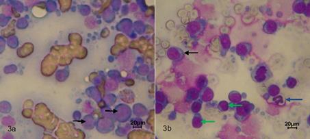 Citolog&iacute;a por BACAF, tinci&oacute;n de Giemsa. (a) Linfonodo Mandibular 40x, proliferaci&oacute;n neopl&aacute;sica de c&eacute;lulas redondas de caracter&iacute;stica linfoide, de gran tama&ntilde;o con evidente alteraci&oacute;n morfol&oacute;gica tanto celular como nuclear (pleomorfismo celular y nuclear, anisocitosis y anisocariosis, megalocitosis y megalocariosis) (flechas negras). (b) Linfonodo popl&iacute;teo 40x, poblaci&oacute;n celular heterog&eacute;nea: c&eacute;lulas plasm&aacute;ticas (flecha negra), neutr&oacute;filos (flecha azul) y linfocitos (flechas verdes).