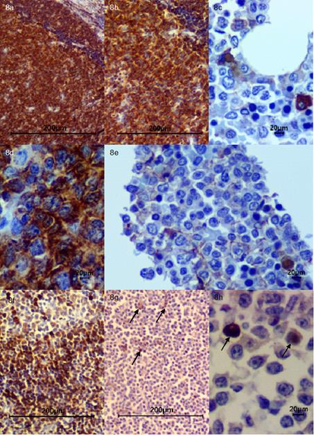 Inmunohistoqu&iacute;mica. (a) Control CD45 N&oacute;dulo linf&aacute;tico 4x; (b) Control CD45 N&oacute;dulo linf&aacute;tico 10x; (c) CD45 M&eacute;dula &Oacute;sea 40x, n&oacute;tese leve inmunomarcaci&oacute;n de c&eacute;lulas neopl&aacute;sicas; (d) Control CD45 N&oacute;dulo linf&aacute;tico 40x; (e) CD45 M&eacute;dula &Oacute;sea 40x, se observan c&eacute;lulas neopl&aacute;sicas con leve inmunomarcaci&oacute;n; (f) Control CD79a N&oacute;dulo Linf&aacute;tico 10x; (g) CD79a N&oacute;dulo Linf&aacute;tico 10x, n&oacute;tese moderada inmunomarcaci&oacute;n para linfocitos B (flechas negras); (h) CD79a N&oacute;dulo Linf&aacute;tico 40x, se evidencia &aacute;reas con moderada inmunomarcaci&oacute;n para linfocitos B (flechas negras).
