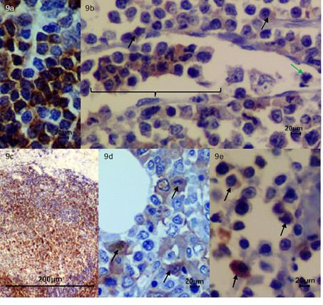 Inmunohistoqu&iacute;mica. (a) Control CD79a N&oacute;dulo linf&aacute;tico 40x. (b) CD79a N&oacute;dulo linf&aacute;tico 40x. N&oacute;tese la moderada inmunomarcaci&oacute;n (flechas negras) y presencia de c&eacute;lulas neopl&aacute;sicas correspondientes a linfocitos B en el lumen de un vaso linf&aacute;tico (llave), presencia de figuras mit&oacute;ticas aberrantes (flecha verde). (c)Control CD79a N&oacute;dulo linf&aacute;tico 4x. (d) CD79a M&eacute;dula &oacute;sea 40x se evidencia moderada inmunomarcaci&oacute;n (flechas negras). (e) CD79a Piel 40x dermis profunda, se evidencia &aacute;reas con moderada inmunomarcaci&oacute;n (flechas negras). 