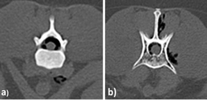 TEM de columna toraco lumbar en vista axial. a) cuerpo vertebral de T13 con &aacute;reas hipodensas de distribuci&oacute;n peri medular dorsal compatible con aire, y que produce alteraci&oacute;n de la densidad en el canal medular y cuerpo vertebral. b) Cuerpo vertebral de L2, aire distribuido en canal medular y en tejido blando perivertebral.