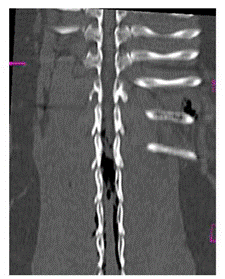 TEM de columna toraco lumbar en vista coronal. &Aacute;reas hipodensas compatible con aire ubicadas caudal a la v&eacute;rtebra T12 y al canal medular que producen alteraci&oacute;n de la densidad vertebral normal. Hipertrofia de las articulares v&eacute;rtebro-costales.
