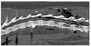 TEM de columna toraco lumbar en vista sagital. &Aacute;reas hipodensas ubicadas en el canal medular y tejido blando dorsal y ventral paravertebral que producen alteraci&oacute;n de la densidad vertebral normal. Osteofitos marginales anteriores tor&aacute;cicos y lumbares.