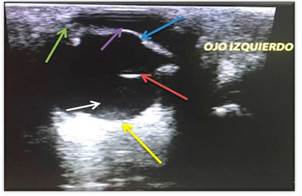 Imagen de ojo izquierdo con su anatomía normal, Corte axial que pasa por el eje óptico. Obsérvese la cápsula anterior (flecha azul) y posterior (flecha roja) del cristalino, cuerpo ciliar (Flecha verde) y retina (flecha amarilla), cámara anterior (flecha morada), cuerpo vítreo (flecha blanca).
