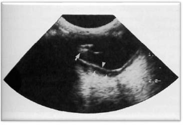 Masa irregular heterogénea de la úvea anterior (flechas). Desprendimiento de retina (puntas de flechas) 11.