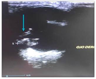 Se evidencia una masa en cuerpo ciliar derecho de dimensión 0,92 por 0,52 cm (flecha azul). Corte coronal, donde se evidencia lesión sobrelevada hipoecogénica de bordes regulares. Se observa compromiso de cuerpo ciliar.