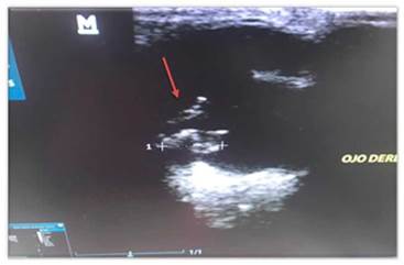 Ecografía ocular confirmando la presencia de masa en cuerpo ciliar derecho y zona iridial (flecha roja). Corte coronal, donde se evidencia lesión sobrelevada, hipoecogénica, de bordes regulares. Se observa compromiso del cuerpo ciliar.
