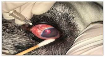 Punción intraocular para extracción de humor acuoso.