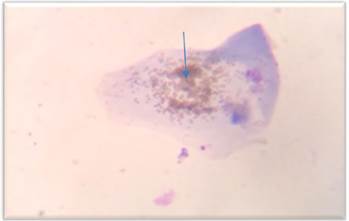 Citología ocular con depósitos melánicos (flecha azul).