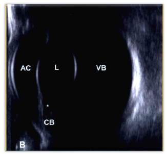 Ecografía de las estructuras oculares normales: * Cámara posterior; C, cornea; L, Cristalino; CB, cuerpo ciliar; AC, cámara anterior; VB, cámara vítrea 10
