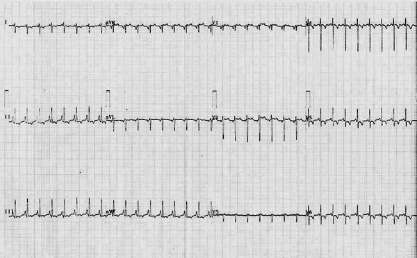 Eletrocardiograma mostrando taquicardia sinusal, eixo do QRS entre +100° e +110° com crescimento do átrio direito e do ventrículo direito, e distúrbios de repolarização em todas as derivações.