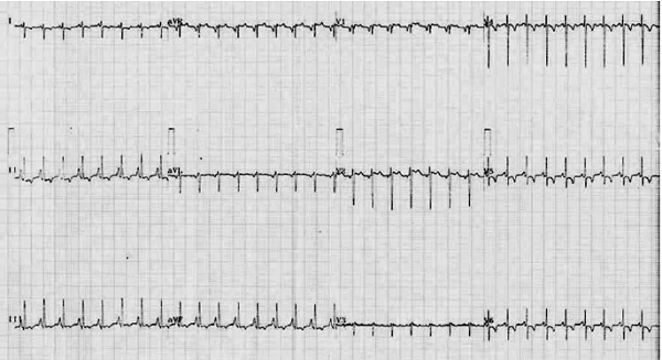  Electrocardiograma mostrando taquicardia sinusal, eje del QRS entre +100&deg; y +110&deg; con crecimiento de aur&iacute;cula derecha y ventr&iacute;culo derecho, y alteraciones de la repolarizaci&oacute;n en todas las derivaciones.