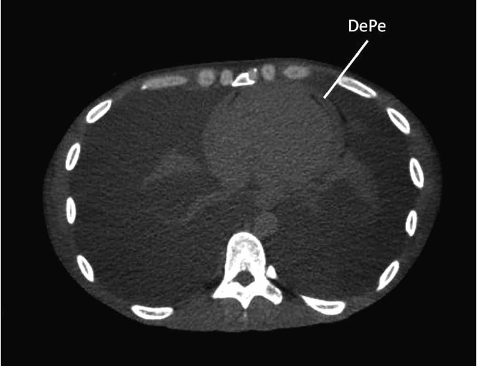 Tomografia computada de t&oacute;rax mostrando el derrame peric&aacute;rdico (DePe).