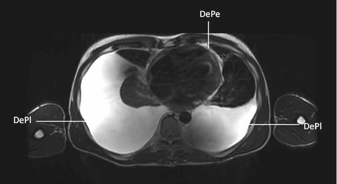 Resonancia magn&eacute;tica nuclear de t&oacute;rax que muestra el derrame pleural bilateral (DePl) y el derrame peric&aacute;rdico (DePe).