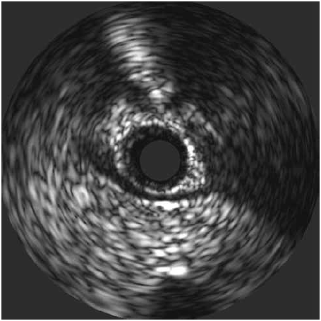 Ecografía intracoronaria: signo de "media luna", área ecolúcida que está presente sólo entre el segmento coronario con puente miocárdico y el tejido epicárdico. Imágen tomada de Michel T Corban el al. JACC 2014; 63(22):2346-235521.