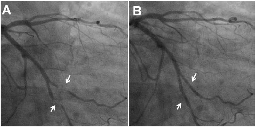 Cinecoronariografía: A. Compresión sistólica de puentes miocárdicos: “efecto de ordeñe”. B. Aumento posterior del diámetro de la luz del vaso durante la diástole. Las flechas blancas indican áreas de puente miocárdico. Imágen tomada de Michel T Corban el al. JACC 2014; 63(22):2346-235521.