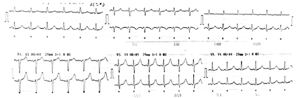Electrocardiograma con taquicardia pero sin cambios isquémicos agudos.