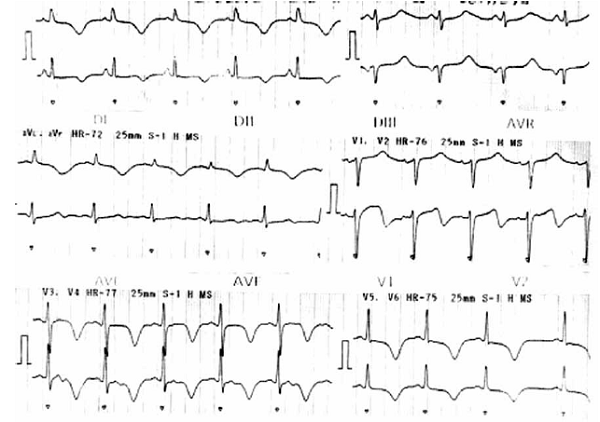 Electrocardiograma mostrando ondas T negativas en cara anterior extensa (V1 a V6, DI, aVL) y QT prolongado (600 mseg).