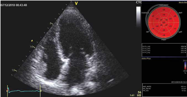 Ecocardiograma vista 4 cámaras apical con normalización de la función ventricular y del strain, sin trastornos de la motilidad.