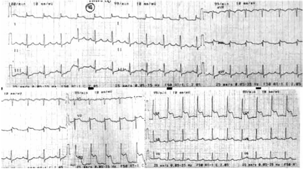 Electrocardiograma post cardioversión eléctrica mostrando la injuria miocárdica.