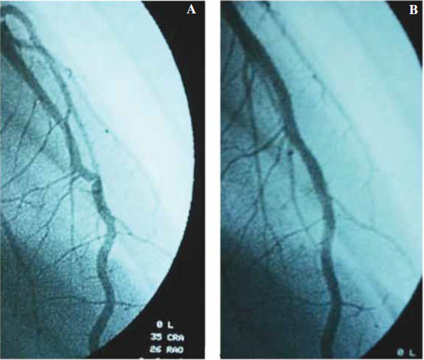 Cinecoronariografía. A. Se observa puente muscular en tercio medio de arteria descendente anterior con colapso sistólico. B. Diástole cardíaca sin colapso arterial.