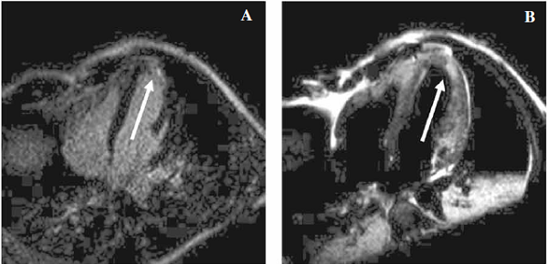 Resonancia magnética nuclear cardíaca. A. Imagen de cuatro cámaras donde se observa la presencia de realce tardío de gadolinio con patrón subendocárdico a nivel de segmentos anteroapical y lateroapical (flecha). B. Imagen de cuatro cámaras en secuencia T2 donde se observan signos de edema miocárdico en segmentos anteroapical y lateroapical (flecha).