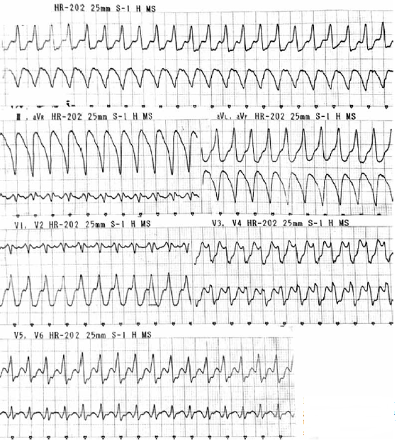 Electrocardiograma que muestra una taquicardia ventricular sostenida.