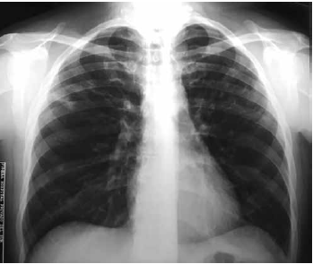Radiografía de tórax con un patrón intersticial bilateral.