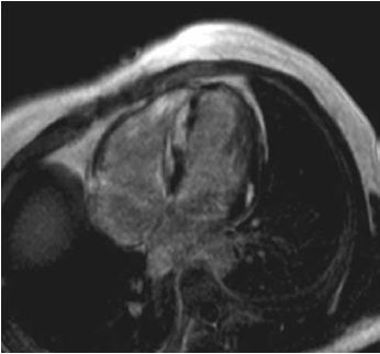 Resonancia magnética nuclear cardíaca en vista transversal que muestra hallazgos compatibles con enfermedad infiltrativa.