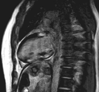 Resonancia magnética nuclear cardíaca en vista sagital con hallazgos compatibles con enfermedad infiltrativa.