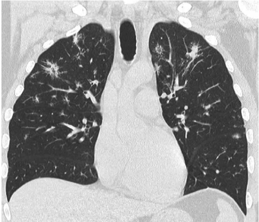 Tomografía computada multislice de tórax que muestra múltiples imágenes ganglionares mediastinales y retropectorales, con nodulillos pulmonares bilaterales a predominio de campos supe riores y medios que al confluir forman conglomerados de aspecto consolidativo.