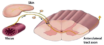Mecanismos de convergencia e hiperalgesia víscero- visceral y víscero-somática. Adaptada de
 (42)

.