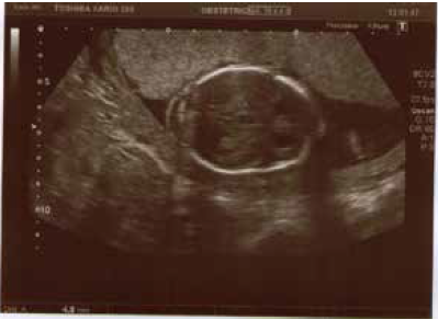 Se evidencia dilatación del tercer ventriculo.