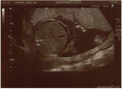 Corte transverso a nivel abdominal, donde se evidencia ascitis fetal.