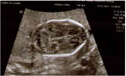 Microcefalia y ausencia casi total de líquido amniótico.