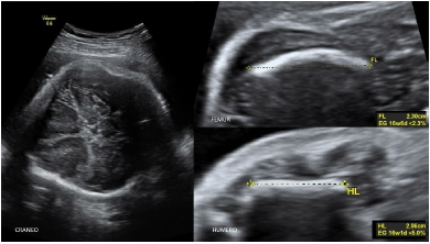 Corte axial del Cráneo mostrando la Forma en trébol. Huesos largos (Fémur y Húmero) acortados.