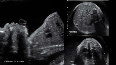 Corte sagital que muestra el estrechamiento del tórax (izquierda). Marcada diferencia de diámetros
entre la circunferencia abdominal
y torácica (derecha).