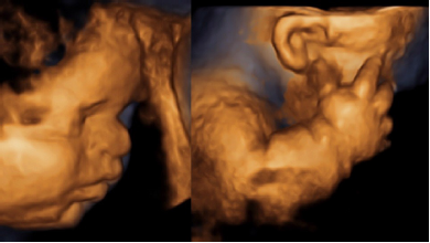  Reconstrucción
3d del perfil facial, mostrando la Frente prominente y el aplanamiento del puente nasal (izquierda). Miembro superior Con marcado acortamiento (derecha).