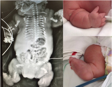  Imágenes del recién nacido: la radiografía muestra el acortamiento severo de los Huesos largos y Costillas.