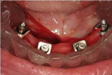 Vista oclusal de transfers ferulizados y gu�a multifuncional en posici�n antes de la toma de impresi�n.