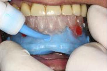 Toma de impresi�n con gu�a multifuncional a boca cerrada.