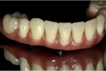 Vista de la pr�tesis h�brida terminada.