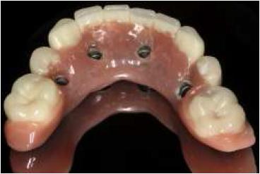 Vista de oclusal de la pr�tesis h�brida terminada.