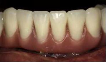 Acercamiento de la rehabilitaci�n reci�n instalada.