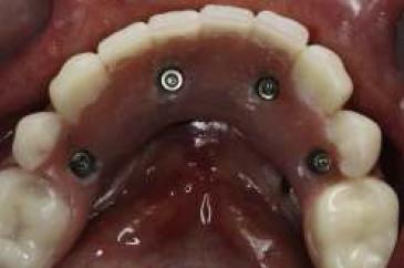 Vista oclusal de la rehabilitaci�n reci�n instalada antes de sellar los accesos de manera temporal.