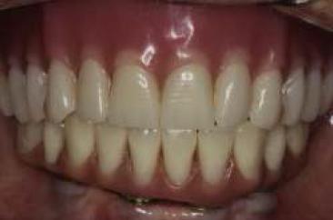 Control a los 2 a�os: vista frontal intraoral.