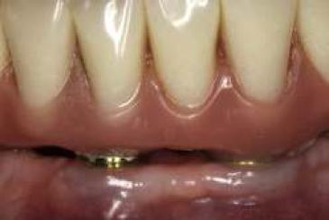 Imagen de acercamiento del ajuste de la rehabilitaci�n, evidenciando la salud de los tejidos periimplantarios.