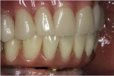 Control a los 2 a�os: vista frontal lateral en oclusi�n.