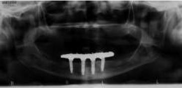 Control radiogr�fico a los 2 a�os del tratamiento.