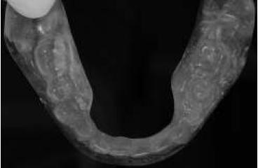 Vista desde oclusal de la gu�a multifuncional.