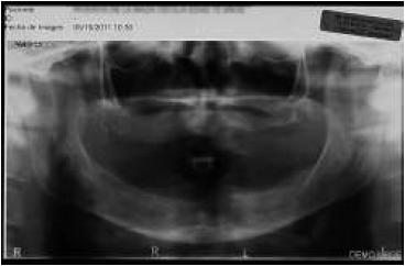 Ortopantomograf�a inicial preoperatoria.